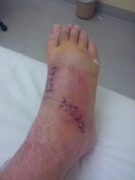 FootStitchesremoved.jpg